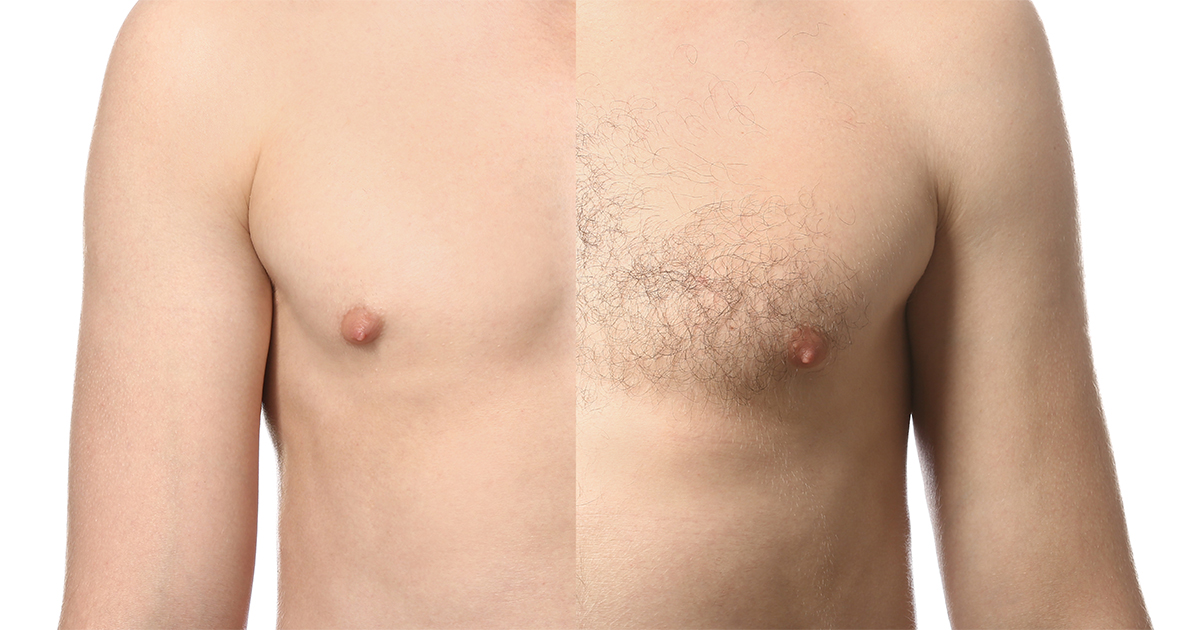 Epilazione Laser