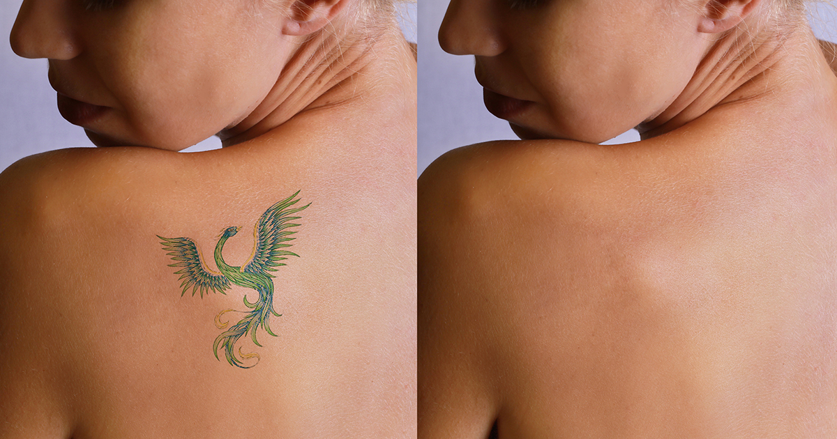 Rimozione tatuaggi
