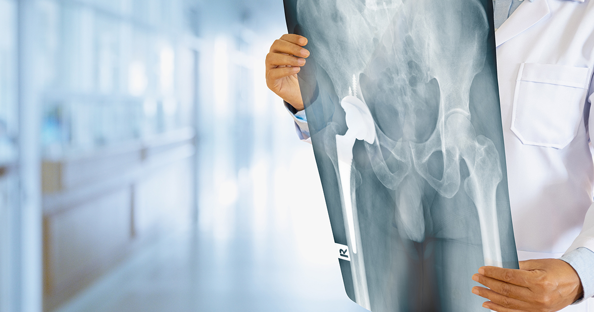 Intervento mininvasivo di protesi dell'anca a Roma